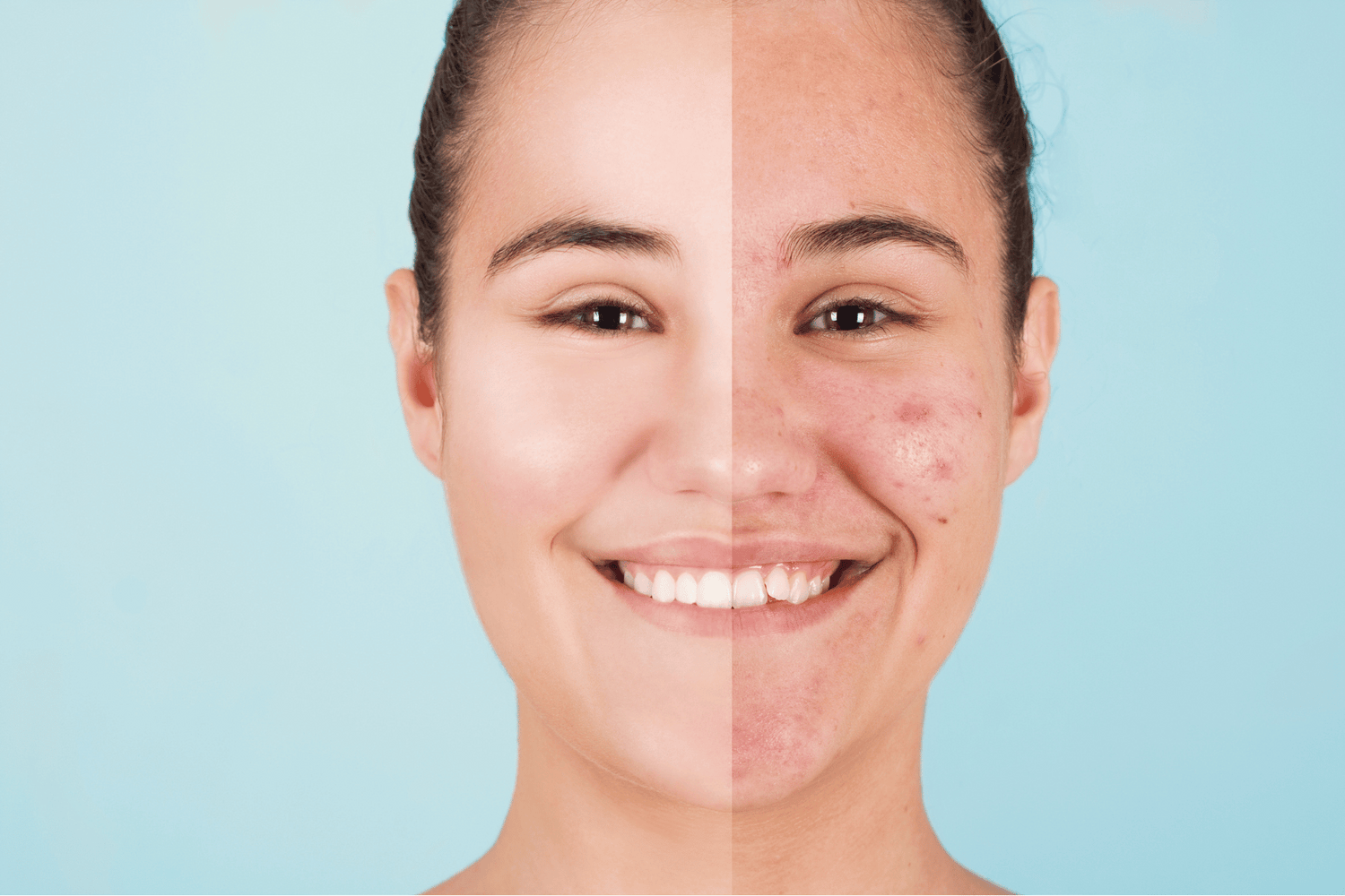 Gli effetti dell’alcool sulla pelle: pelle infiammata, acne